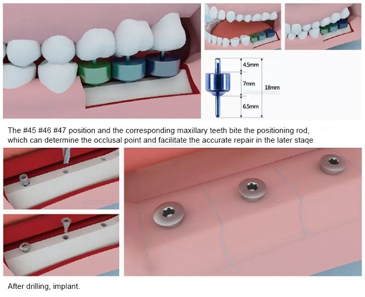 Dental Implant Surgical Guide Drill Guide Pin Bone Trimmer and Bone Collector Kit
